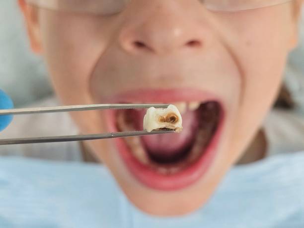 Best Emergency Wisdom Teeth Removal in Emmett, ID
